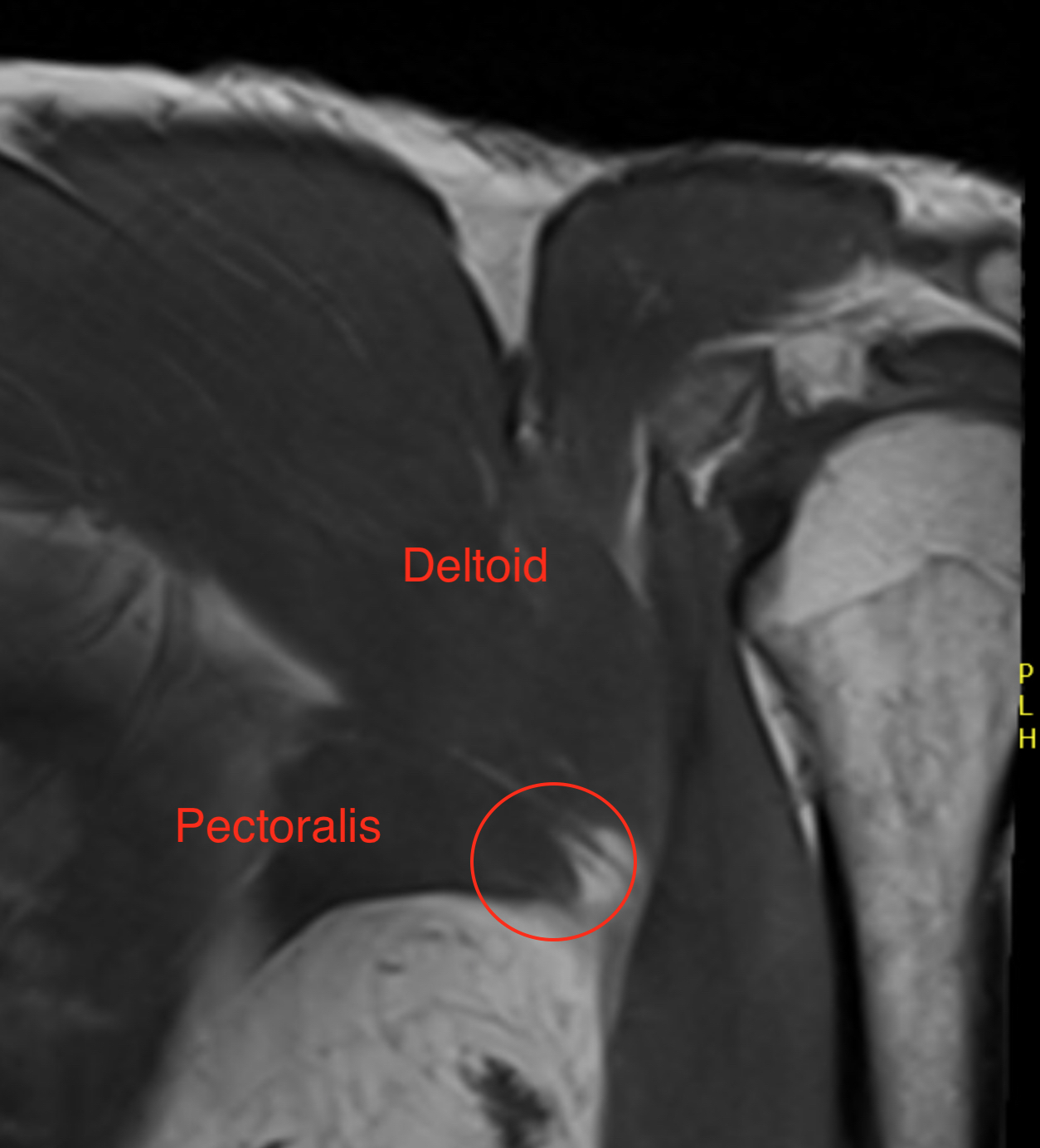 Pectoralis 3